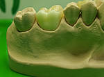 Dental Keramik Becker Leistungsspektrum e.max Kronen