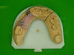Dental Keramik Becker Leistungsspektrum Implantatarbeiten