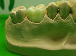 Dental Keramik Becker Leistungsspektrum Onlays